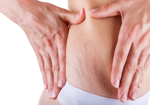 A woman with white stretch marks