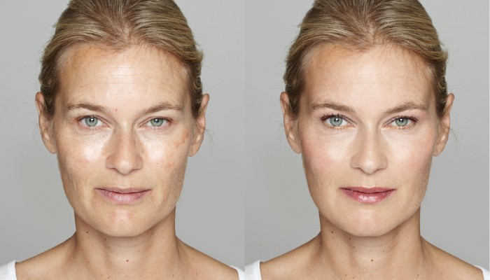 A woman before and after microdermabrasion